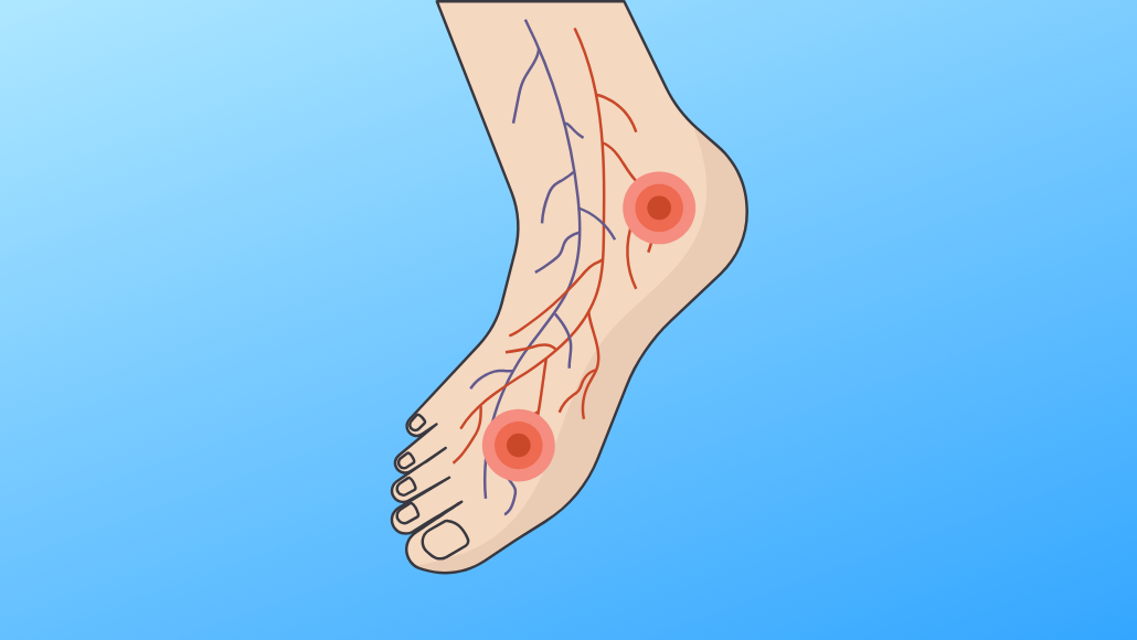 The Diabetic Foot Guide: Problems and Prevention